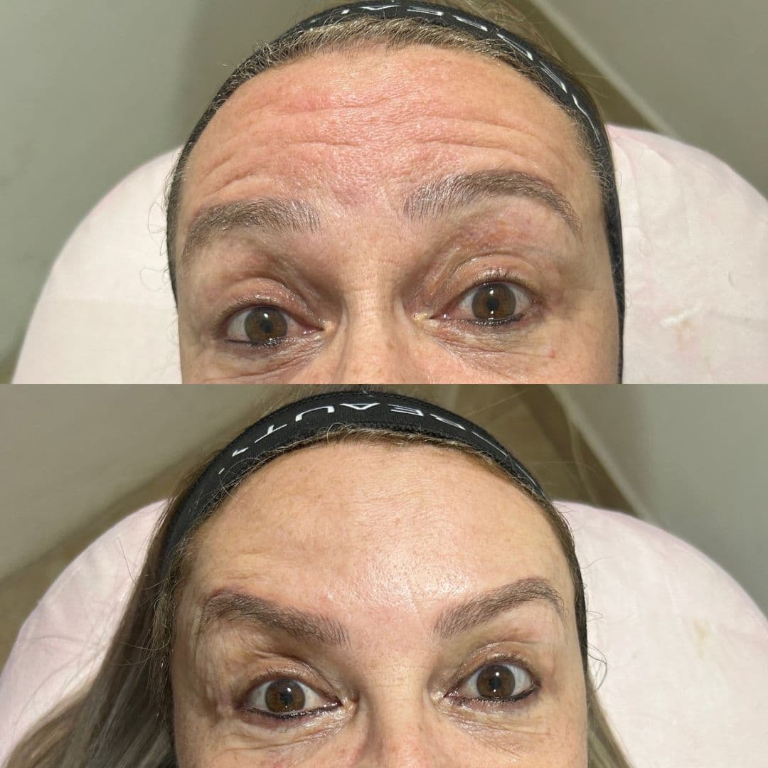 Comparação antes e depois em harmonização orofacial